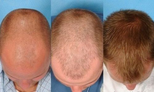 hair-transplantation-750x400-1