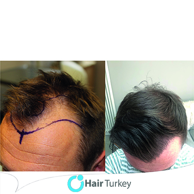 10 Reasons To Get Your Hair Transplant Surgery in Turkey - Hair Turkey