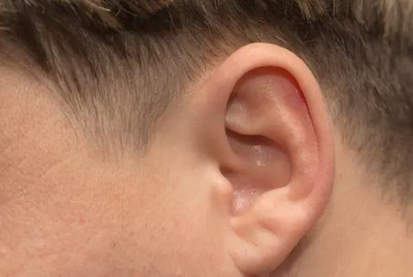Ear Surgery