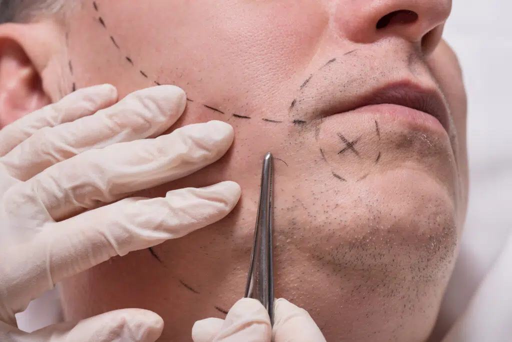 Man beauty procedure beard hair implant for senior man
